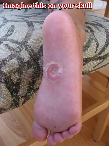 Hand with histiocytosis of the skin